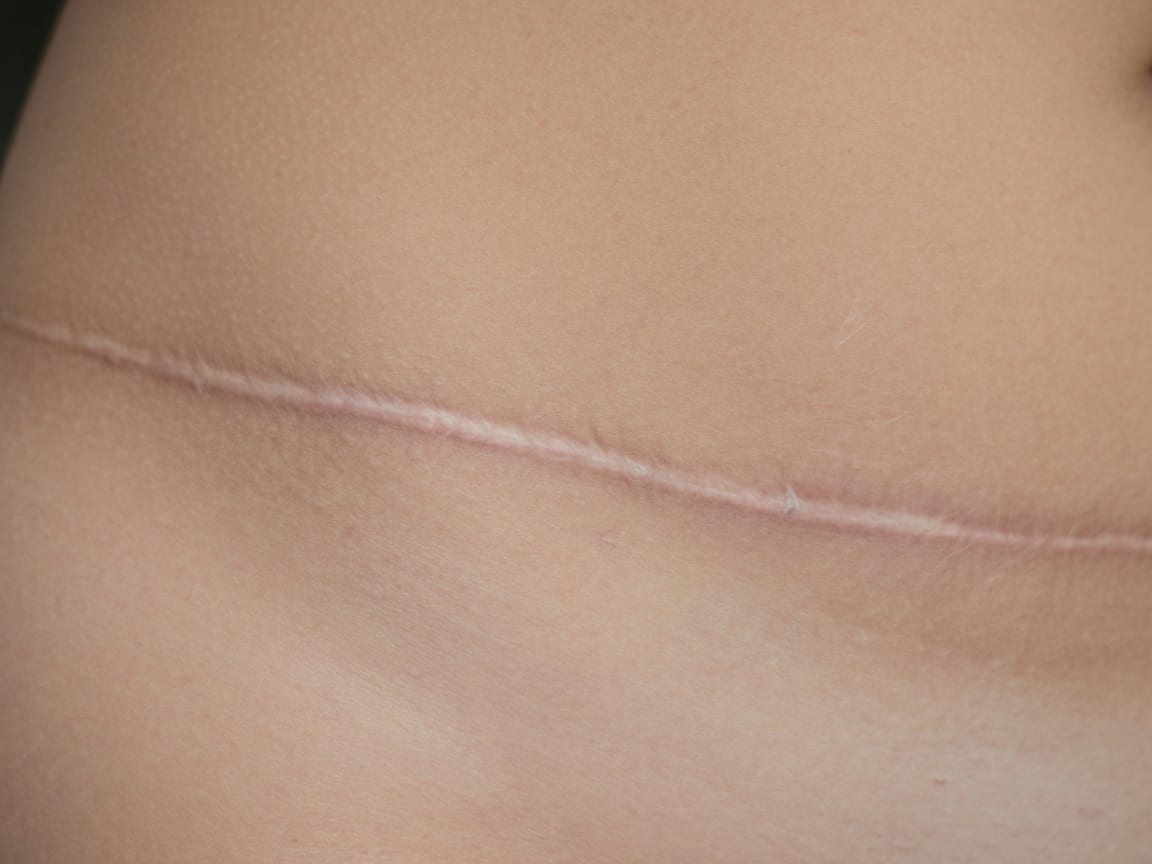 Large Areas Scar permanent makeup